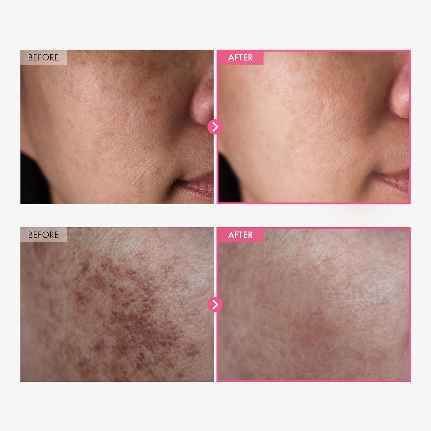 Zermet 1 Arbutin 7% + Tranexamic Acid 4% Cream, 70,000ppm Arbutin, 40,000ppm TXA, Niacinamide, Glutathione, Dark Spots, Freckle, Blemishes, Pigmentation, Korean Skin Care, 50ml, 1.69 fl.oz.