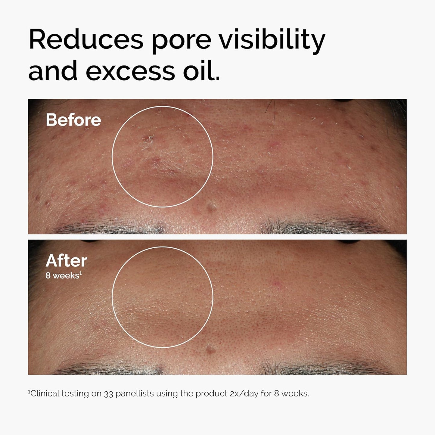 Zermet 1 The Ordinary Niacinamide 10% + Zinc 1%, Smoothing Serum for Blemish-Prone Skin