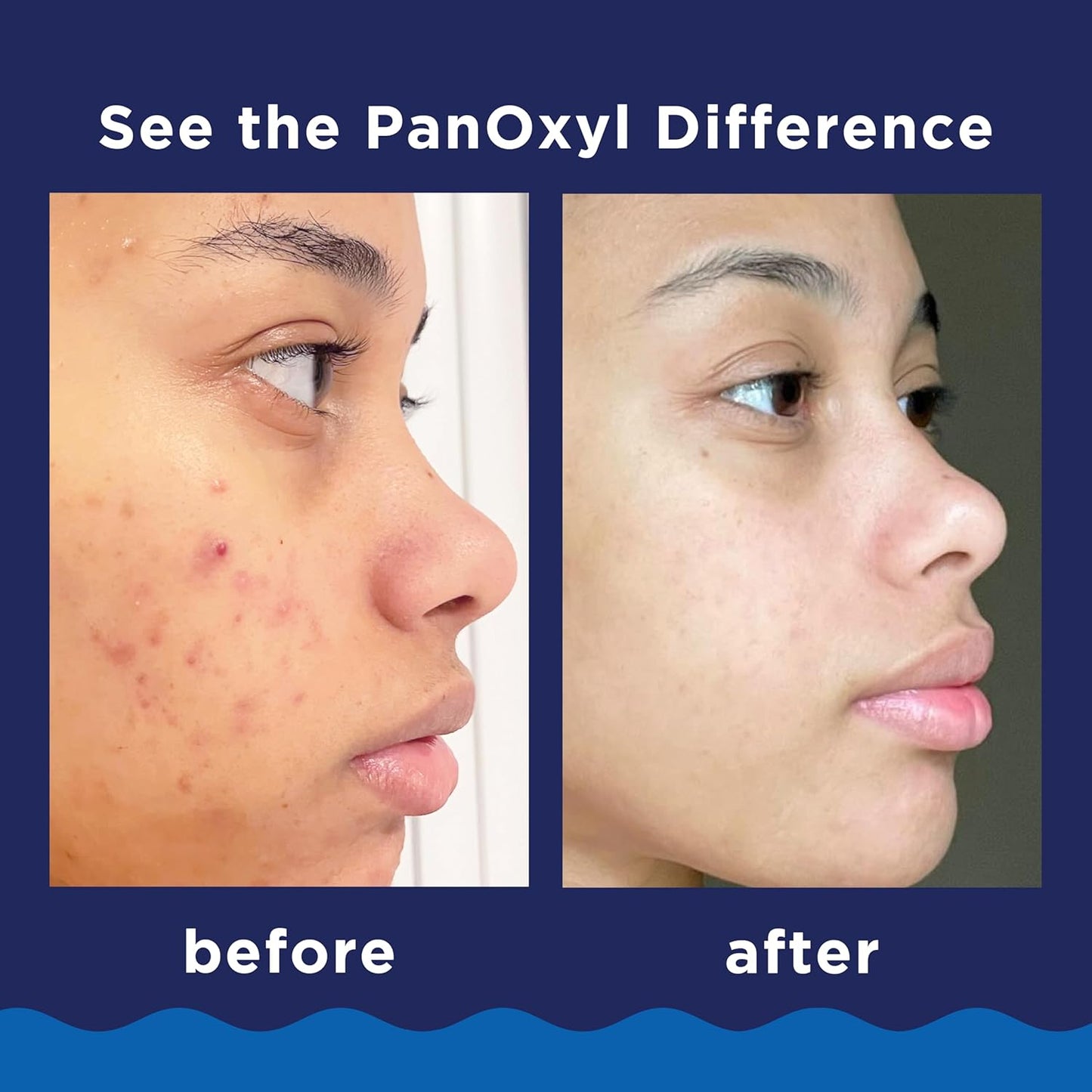 Zermet 1 PanOxyl Acne Foaming Wash Benzoyl Peroxide 10% Maximum Strength Antimicrobial, 5.5 Oz