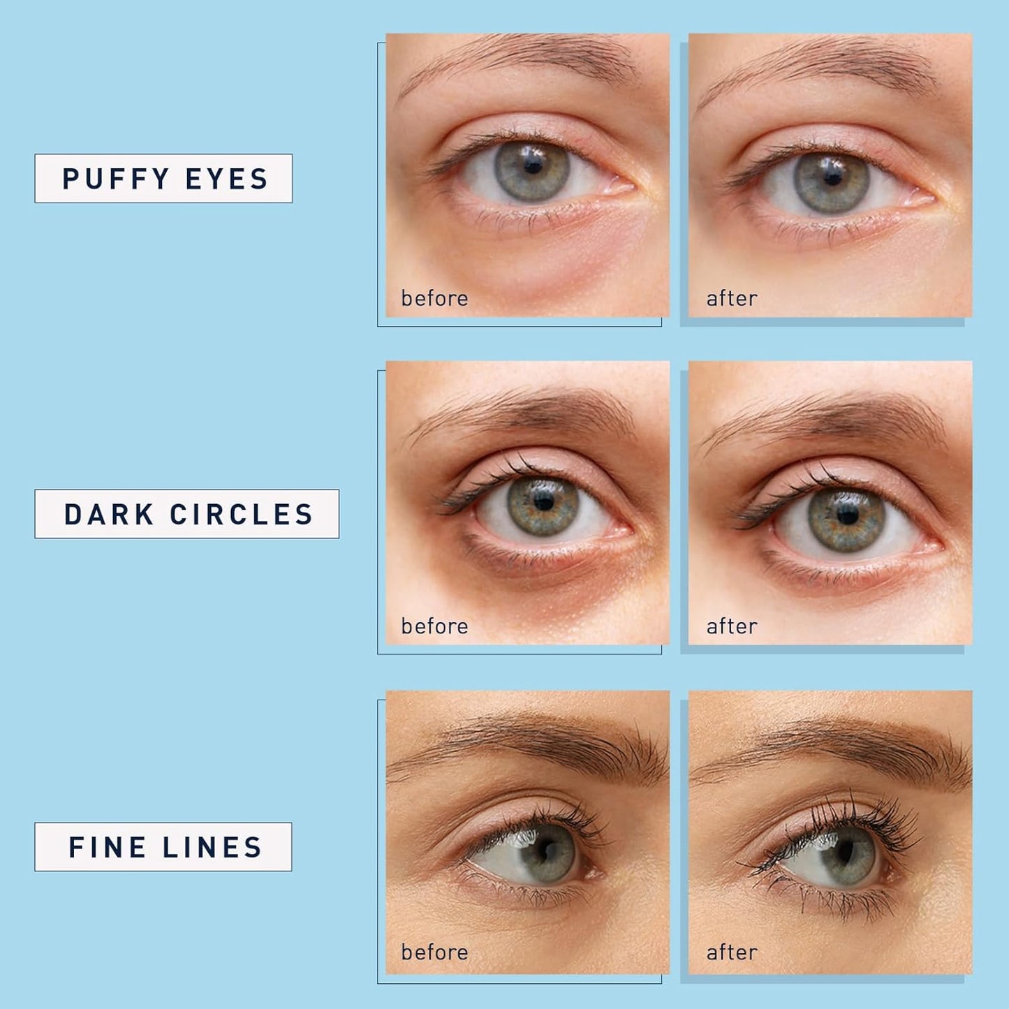 Zermet 1 Enaskin Naturals Under Eye Patches for Dark Circles: 30 Pairs Retinol Collagen Eye Gels Mask - Reduce Wrinkles Puffy & Bags - Skin Treatment Pads - Anti Aging Moisturizer For Women (Blue)